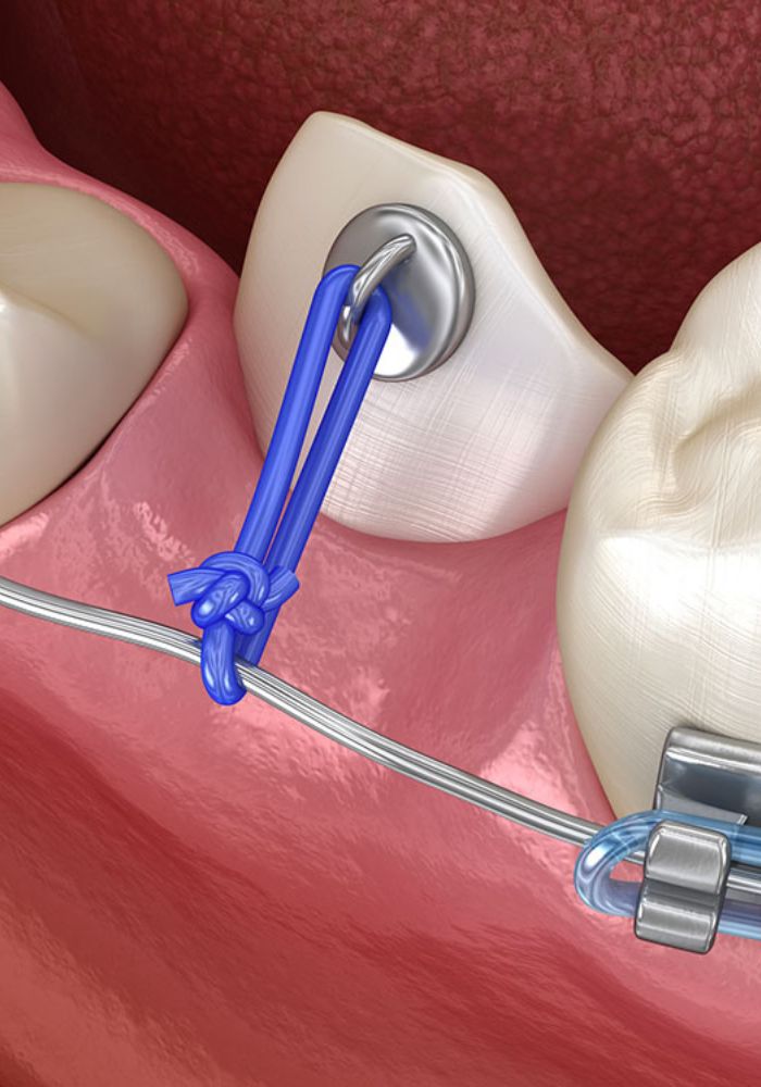 Dégagement des dents incluses - Rouen - Dr Jérôme Adnot