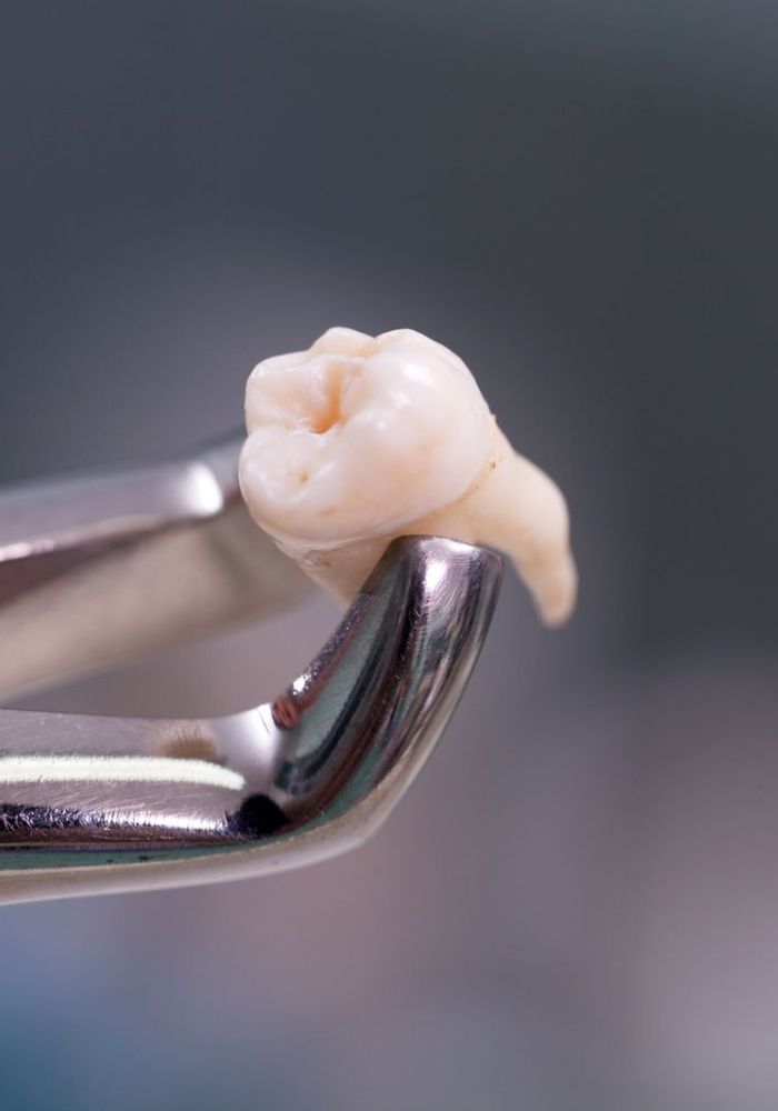 Extraction dentaire - Rouen - Dr Jérôme Adnot