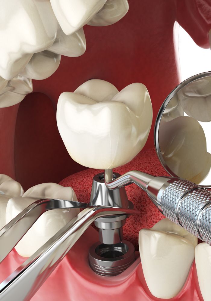 Réhabilitation complète par implants - Rouen - Dr Jérôme Adnot
